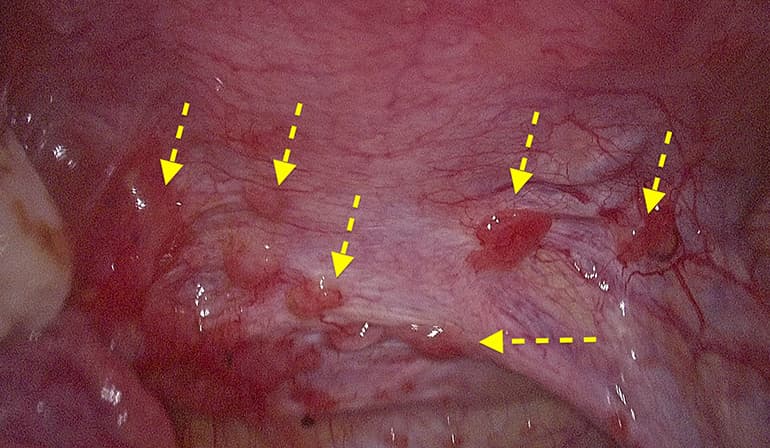 Endometriosis