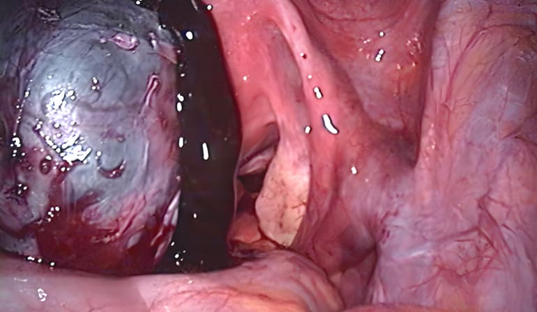 Cirugía para endometriosis
