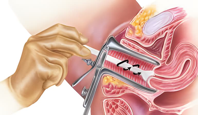 Papanicolaou (citología cervical)